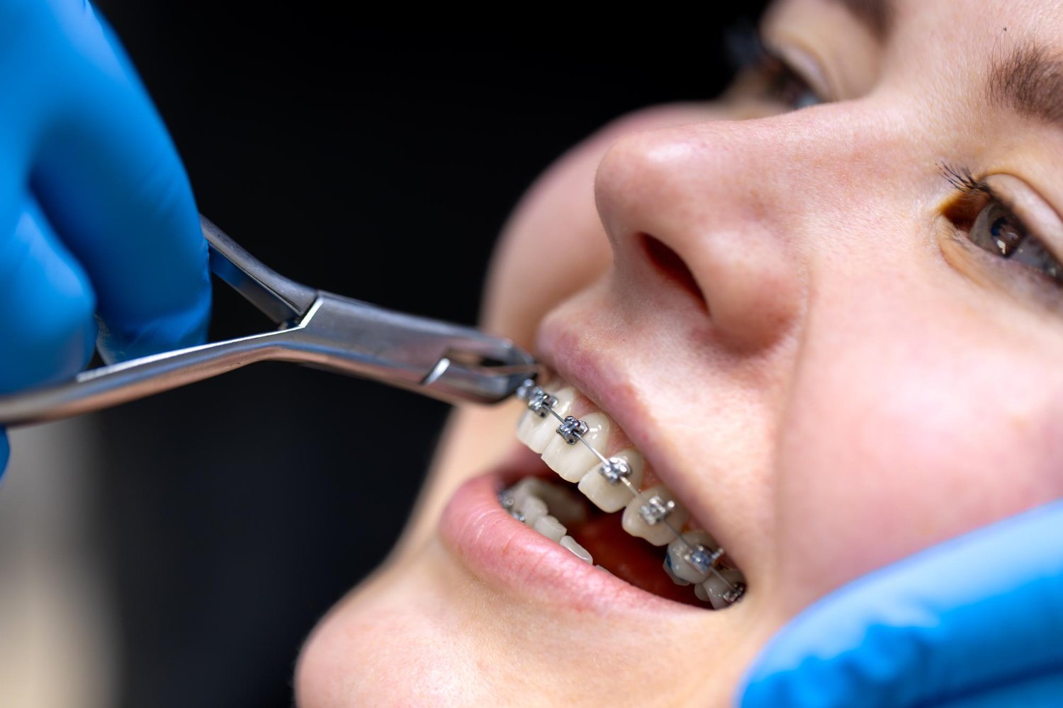 Paciente con tratamiento de ortodoncia en clínica dental en Cumbayá