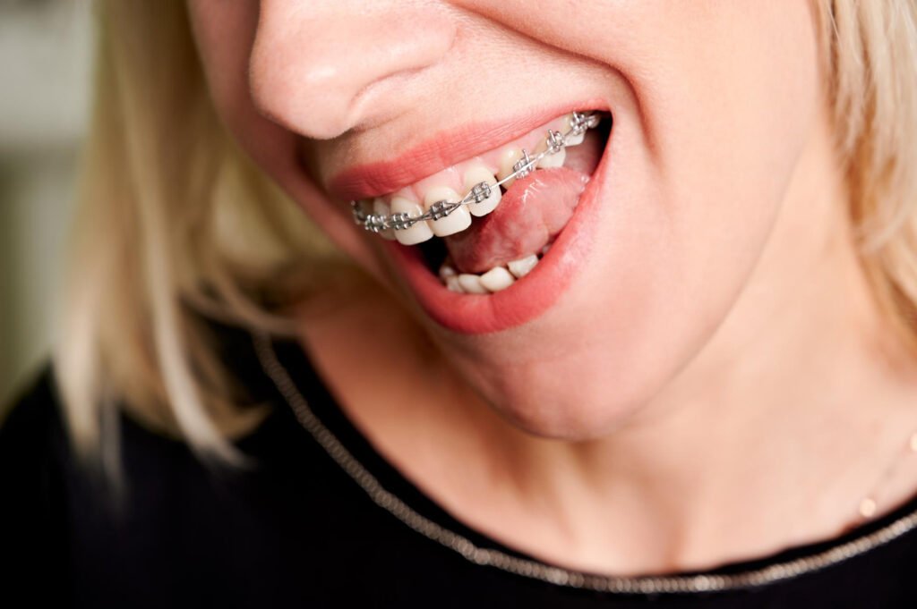 Paciente cepillando sus dientes con brackets en Cumbayá, cuidado de ortodoncia
