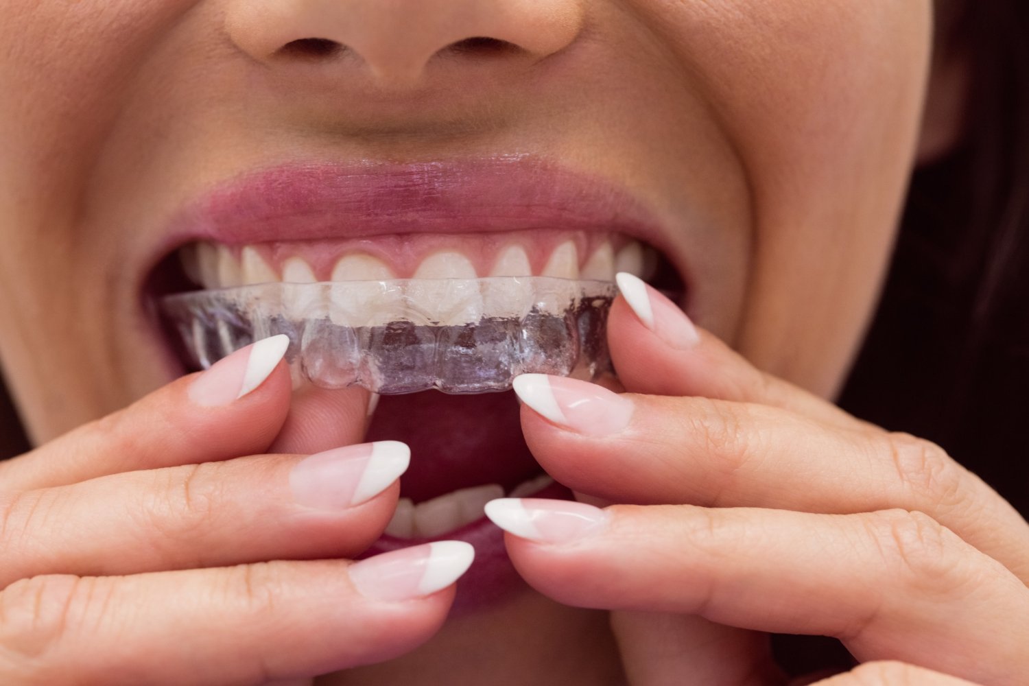 Paciente comparando brackets y alineadores invisibles en Cumbayá, ortodoncia profesional